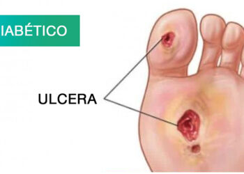 Las heridas por trauma y las úlceras de pie diabético representan la mayor demanda en atención médica