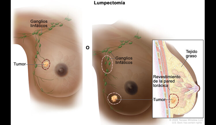Es posible reducir el riesgo de cáncer de mama con tan solo cuatro hábitos: Comité de Médicos por una Medicina Responsable 