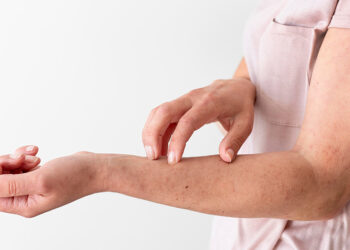 Concentran cinco municipios el 60% de casos de dengue: Salud