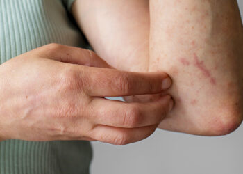 Acumula Puebla 4 mil 399 casos de dengue en 2024: Salud