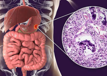 México registra más de 9 mil nuevos casos de cáncer de estómago