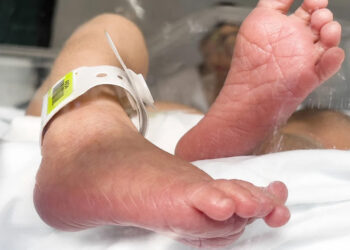 Reportan casi 3 mil casos de tos ferina en el país