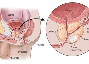 Incorporan al Sector Salud innovadora terapia de Bayer contra el cáncer de próstata para pacientes en etapas avanzadas