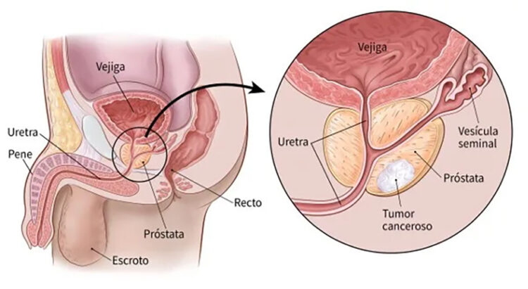 Incorporan al Sector Salud innovadora terapia de Bayer contra el cáncer de próstata para pacientes en etapas avanzadas
