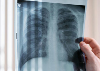 Innovadora molécula de Boehringer Ingelheim frena deterioro en Fibrosis Pulmonar