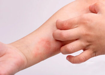 AbbVie impulsa el conocimiento y la visibilidad de la Dermatitis Atópica ante el impacto de esta enfermedad.