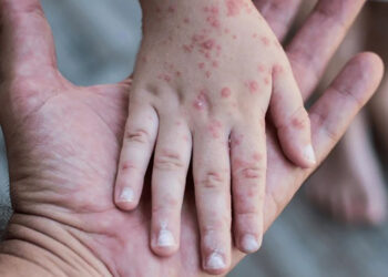 Gobierno mantiene atención en escuelas ante brotes de coxsackie