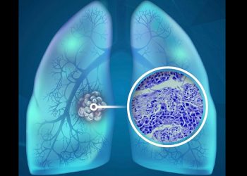 Abbott fortalece su presencia en oncología con una nueva inmunoterapia para cáncer de pulmón de células pequeñas en etapa extensa, ofreciendo una nueva alternativa para los pacientes